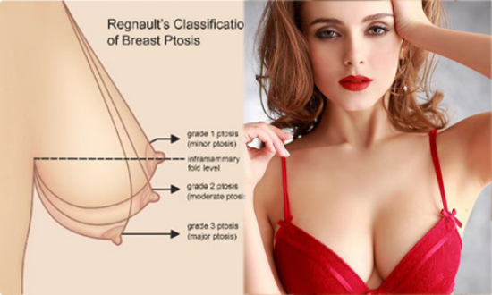 ngực xệ cách khắc phục