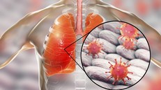 Virus tấn công đường hô hấp gây bệnh phổi có thể dẫn tới tử vong