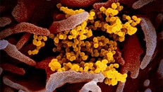 Biến chứng của virus Sars-CoV-2 gây ra hội chứng DIC.