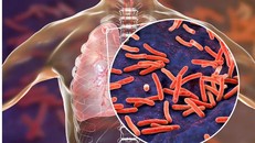 Bệnh lao là bệnh do vi khuẩn có hại gây ra. Vi khuẩn này thường lây nhiễm sang phổi khiến bệnh nặng thêm. Ảnh: livescience.com
