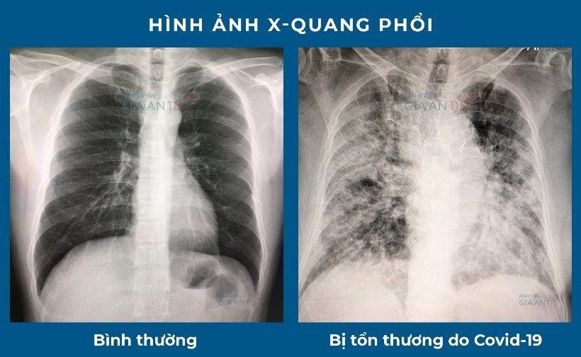 Hình ảnh X-quang phổi bị tổn thương do COVID-19. (Ảnh: Kiểm Sát Online)
