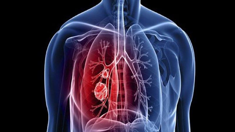 COVID-19 làm tăng nguy cơ tắc động mạch phổi