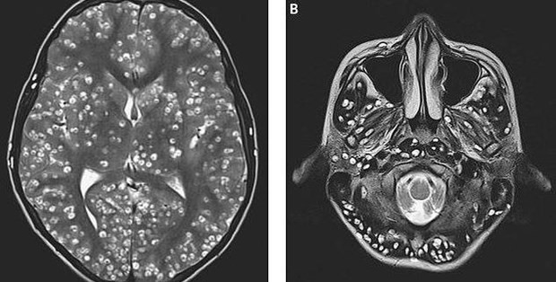 Kết quả chụp MRI cho thấy chàng trai có nhiều nang sán trong vỏ não (hình bên trái là các chấm trắng). Các tổn thương cũng được tìm thấy trong thân não và tiểu não của anh ta (nhìn bên phải).
