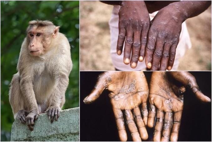 WHO khuyến cáo về bệnh đậu mùa khỉ - thường thấy ở Trung Phi và Tây Phi