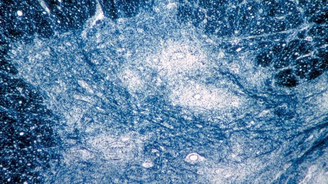 Hình ảnh trên kính hiển vi do CDC Mỹ cung cấp cho thấy virus bại liệt đối tấn công mô tủy sống của người. Ảnh: AP