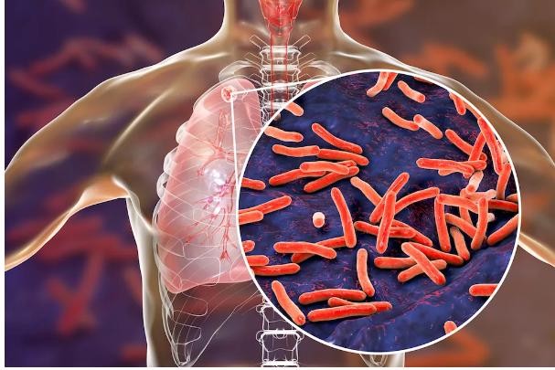 Bệnh lao là bệnh do vi khuẩn có hại gây ra. Vi khuẩn này thường lây nhiễm sang phổi khiến bệnh nặng thêm. Ảnh: livescience.com
