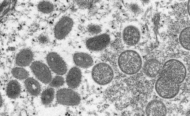 Hình ảnh dưới kính hiển vi cho thấy virus đậu mùa khỉ trong mẫu bệnh phẩm của một bệnh nhân. (Ảnh: Reuters/TTXVN)