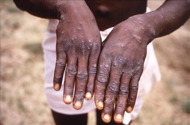 Bàn tay của bệnh nhân mắc đậu mùa khỉ. Ảnh: AFP/TTXVN