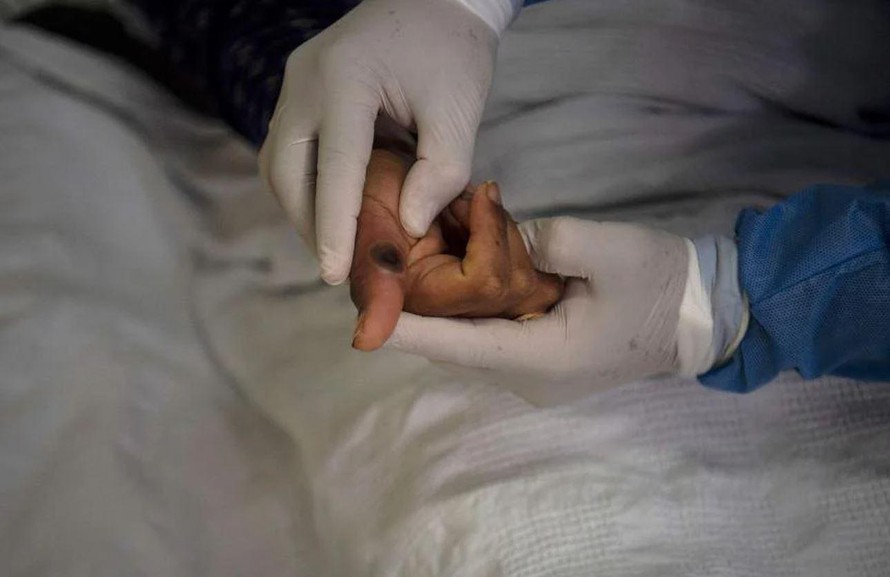 Bàn tay của một bệnh nhân đậu mùa khỉ. Ảnh: AFP