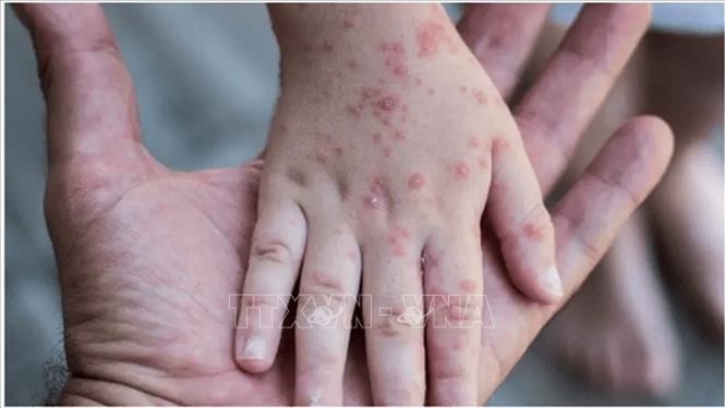 Bàn tay người mắc bệnh đậu mùa khỉ ghi nhận tại các nước. Ảnh: Reuters/TTXVN